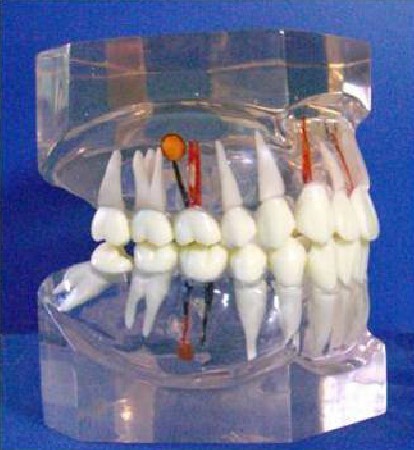 <b>透明牙体病理模型</b>
